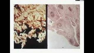 Histopathology JointRheumatoid arthritis [upl. by Eibbor]