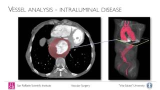 Open thoracoabdominal aortic aneurysm repair intorduciton anatomy and perioperative management [upl. by Jennifer]