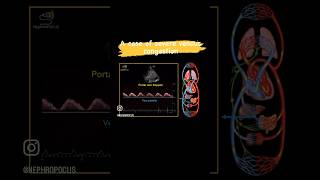 Systemic venous congestion case  VExUS  eVExUS extended VExUS  Dr Koratala [upl. by Nerag304]