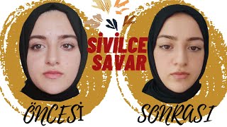 Sivilcelerimden nasıl kurtuldum🙅‍♀️ Roaccutane Kullanmadan Benzoxin [upl. by Ichabod]