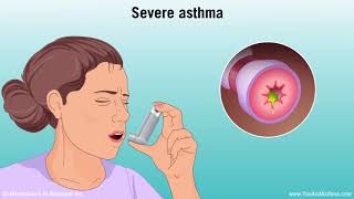 Understanding Asthma Mild Moderate and Severe [upl. by Islean]