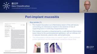 Periimplant mucositis  tutorial by Tord Berglundh [upl. by Ireland439]