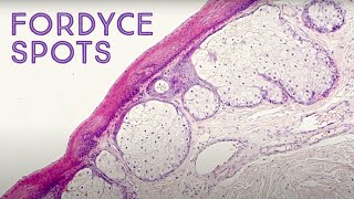 Fordyce Spots quotoil glandsquot under the microscope Montgomery tubercles Tyson glands sebaceous [upl. by Tnilk]