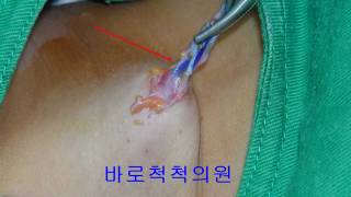 새열낭 branchial cleft cyst 鰓裂囊  전이개낭종preauricular sinus 수술하기 [upl. by Allen]