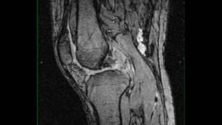 Pigmented Villonodular Synovitis Knee [upl. by Onibag]