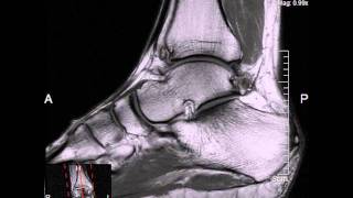 MRI on my ankle [upl. by Mcgrody121]