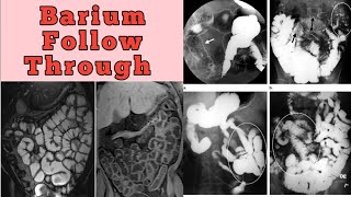 Barium Follow Through Complete Study [upl. by Truda]