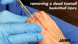 REMOVING A DEAD TOENAIL  more satisfying than removing an ingrown toenail [upl. by Morey450]