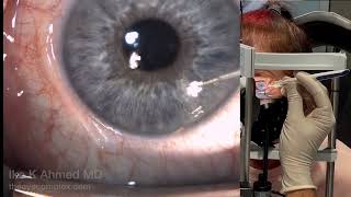 Glaucoma Drug Delivery into the Eye Durysta Bioerodible Implant [upl. by Sheffie223]