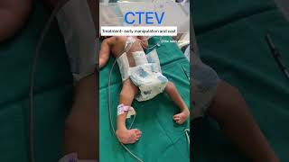 CTEV  congenital talips equino varus  the baby doctor newborn shorts ctev ytshorts pediatric [upl. by Loy]