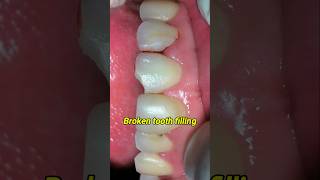 Fix broken tooth filling dentist dentisty tooth [upl. by Aicenra92]