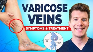 Varicose Veins Explained Causes Symptoms amp Treatment [upl. by Lenrow970]