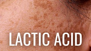 WHY Lactic Acid is Best For Hyperpigmentation [upl. by Atinuaj]