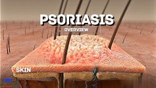 Psoriasis Overview [upl. by Madelyn]