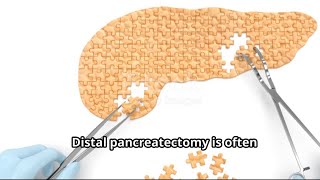 My Distal Pancreatectomy Experience What to Expect [upl. by Sihonn]