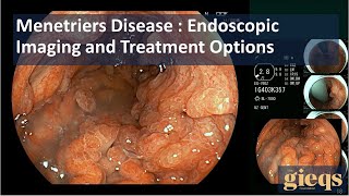 Menetriers Disease  Endoscopic Imaging and Treatment Options [upl. by Kimmie478]