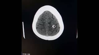 Normal pressure hydrocephalus Reduced callosal angle [upl. by Eutnoj]