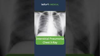 Understanding Interstitial Pneumonia 🫁 MedicalEducation usmle [upl. by Natascha817]