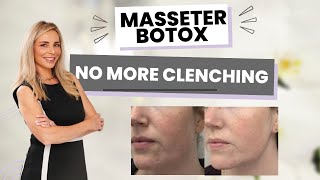 What is Masseter Botox Expert Injector Explains How it Results in a Snatched Jaw amp Better Sleep [upl. by Vezza]