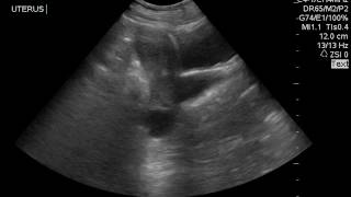 AIUM Case Challenge 46 Transabdominal ultrasound [upl. by Sualohcin]