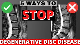 5 Ways To Stop or Delay Degenerative Disc Disease [upl. by Nodnerb142]