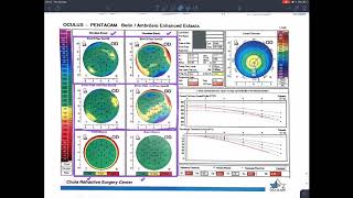 Tutorial Basic Corneal Tomography Pentacam Reading for Beginner in Thai Language [upl. by Idnahc]