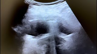 Ultrasound of Emphysematous cystitis in 65 yr diabetic female [upl. by Litnahs225]