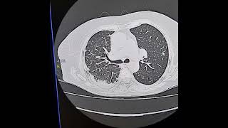 Cryptogenic organising pneumonia [upl. by Heywood]