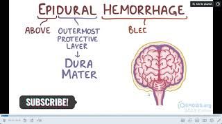 EPIDURAL HEMATOMA Pathology CNS mednex osmosis [upl. by Struve]