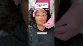 ENTIRE 7 Day chemical peel shedding process for hyperpigmentation on brown skin‼️🫶🏽 chemicalpeel [upl. by Chemush]