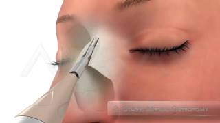 Video Endoscopic Micro Rhinoplasty Dr Yakup Avsar [upl. by Cul]