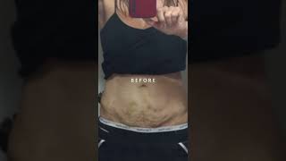 FasciaBlasting STOMACH Before and After [upl. by Bamberger384]