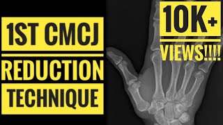 1st CMCJ Carpometacarpal JointReduction Technique [upl. by Hurlbut]