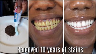 in two minutes remove 10 years of stains from teeth Results will Shock You [upl. by Occor]