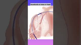 Recanalización de trompas de Falopio [upl. by Eldnik]