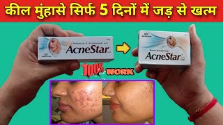 acnestar gel review एक्ने पिंपल्स जड़ से खत्म करने की दवा acnestar gel kaise use kare  acnestar [upl. by Rikahs]