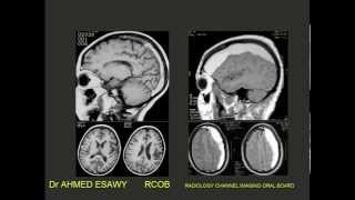 1Radiology Channel Imaging oral board of CNS I imaging [upl. by Ahsinar]