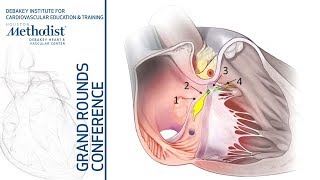 HisBundle Pacing Amish Dave MD PhD September 27 2018 [upl. by Slaughter]