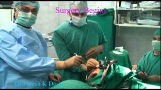 DBS Surgery for Parkinsons disease  DrParesh K Doshi [upl. by Aisila163]