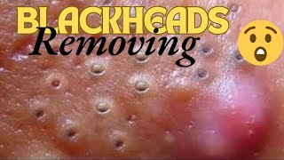 Satisfying Blackheads Removal 😲😯 Blackheads problem blackheads blackheadextraction satisfying [upl. by Icaj]