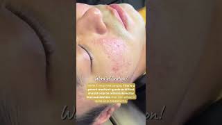 TCA Cross for Acne Scars [upl. by Ennylcaj]