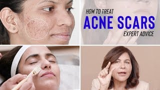 Treatments for ACNE SCARS  Dr Bindus Expert Advice [upl. by Eintrok25]