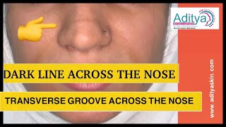 DARK LINE ACROSS THE NOSE  PIGMENTATION ON NOSE  TRANSVERSE NESAL GROOVE  LASER TREATMENT by DR [upl. by Trahern962]