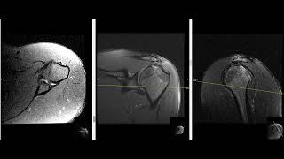 23 year old male with shoulder pain [upl. by Arihday240]