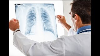 Comment poseton le diagnostic de fibrose pulmonaire idiopathique [upl. by Donaugh]