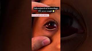 Subconjunctival hemorrhage HX sever cough 😷 hemorrhage shorts ophthalmology ophthalkripa eyes [upl. by Theurich]