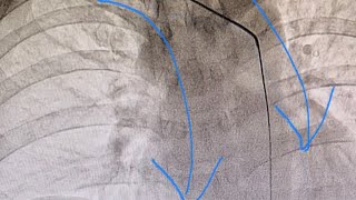 Taking A Deep Breath May Straighten The Right Subclavian ArteryAscending Aorta Curve [upl. by Ynnij915]