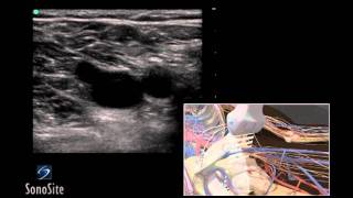 How To Deep Vein Thrombosis Ultrasound Exam 3D Video [upl. by Aikrahs174]