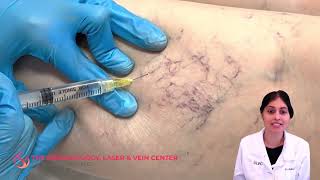 Sclerotherapy Varicose and Spider Vein Treatment  Dr Shalini Gupta [upl. by Donia567]