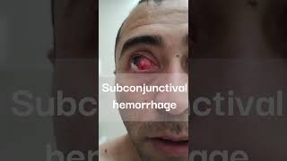 Subconjunctival hemorrhage ophthalmology hemorrhage health [upl. by Zetnas188]